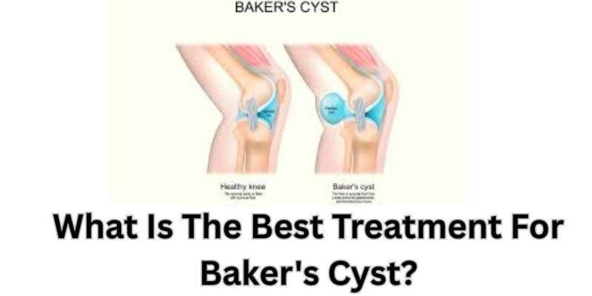 What Is The Best Treatment For Baker's Cyst?