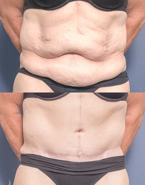 Body Surgery Procedures in Brisbane - Dr Raymond Goh