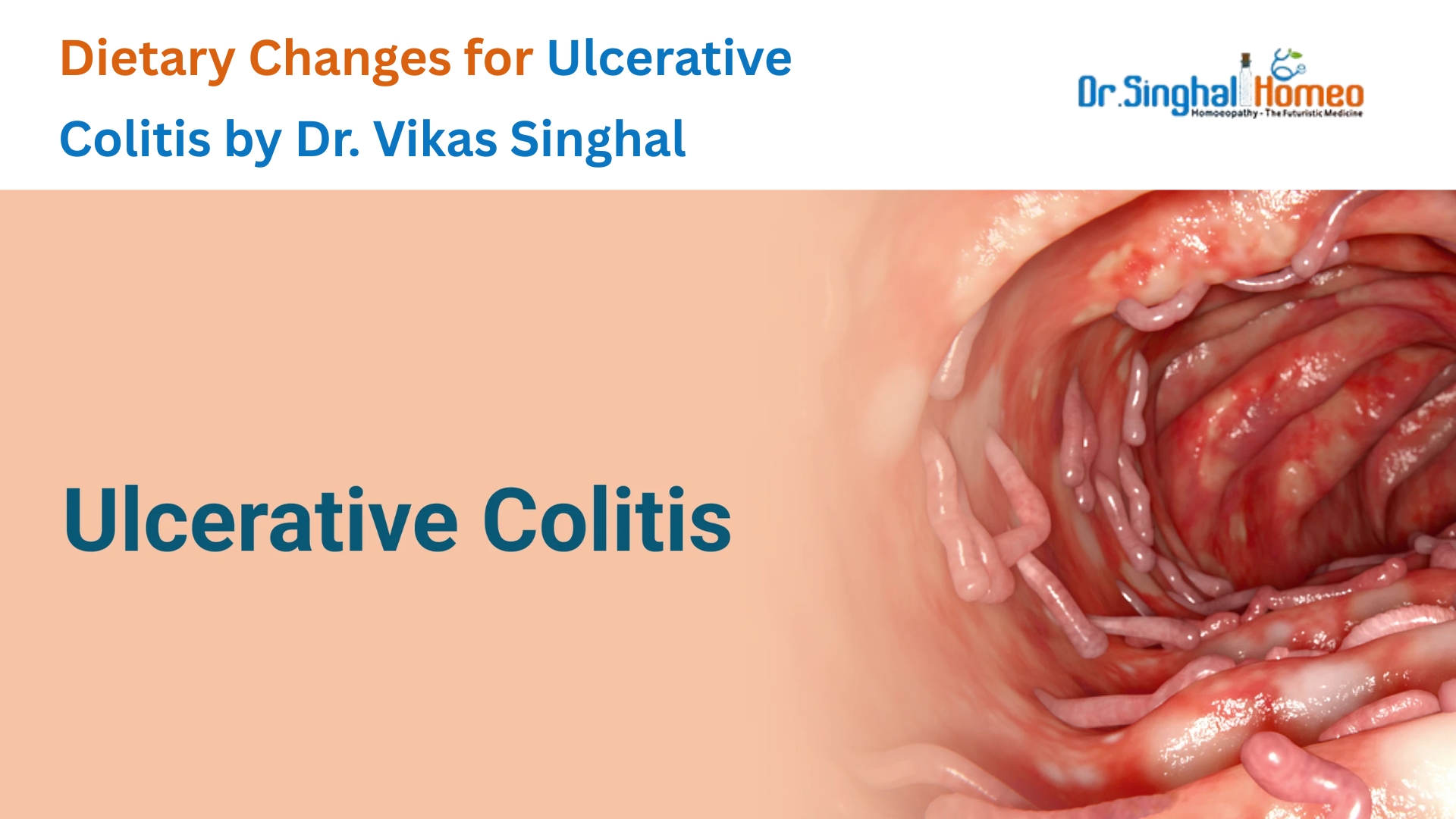 Eating Your Way to Better Health: Dietary Changes to Help Reduce Ulcerative Colitis Symptoms – health