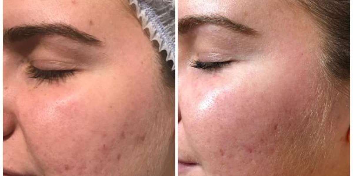 Microneedling London: Reveal Radiant, Smooth Skin with the Treatment Everyone’s Talking About