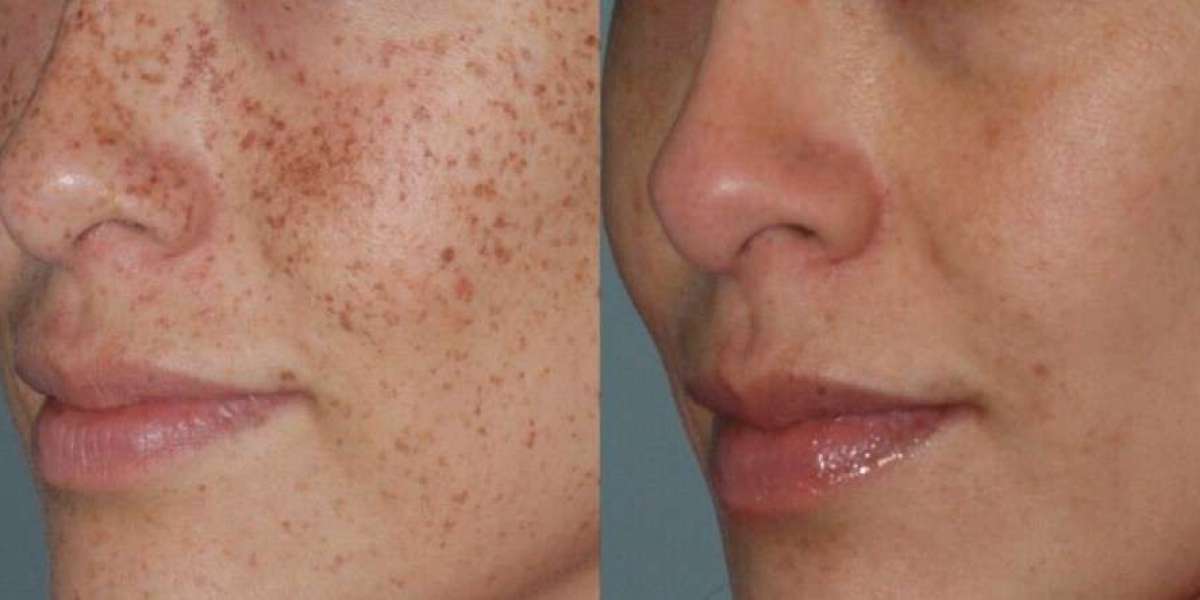 How Climate Affects Skin Pigmentation and Treatment in Riyadh