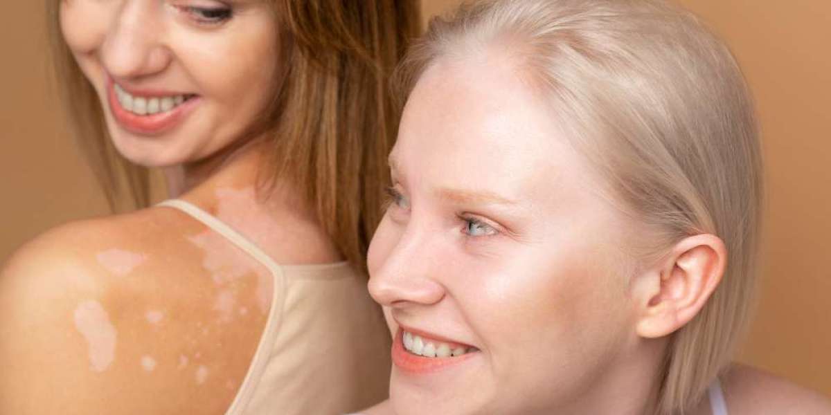 Homeopathy Treatment for White Patches on Skin: Restore Pigment Naturally