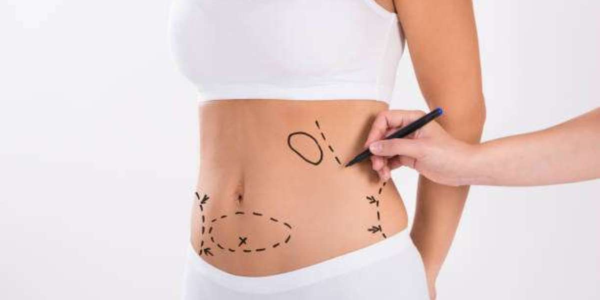 Understanding Liposuction Suitability: Is It Right for You?