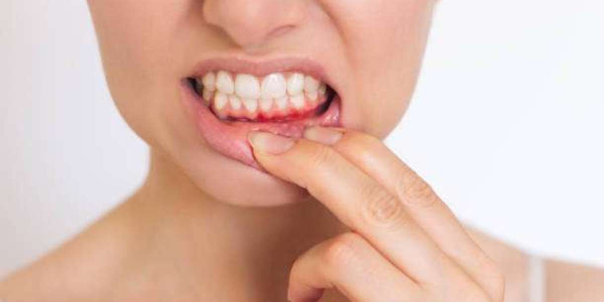 Can Insurance Help Cover the Cost of Gum Recession Treatment?