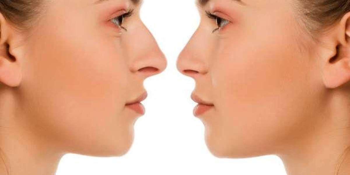 What Makes a Good Candidate for Modern Rhinoplasty
