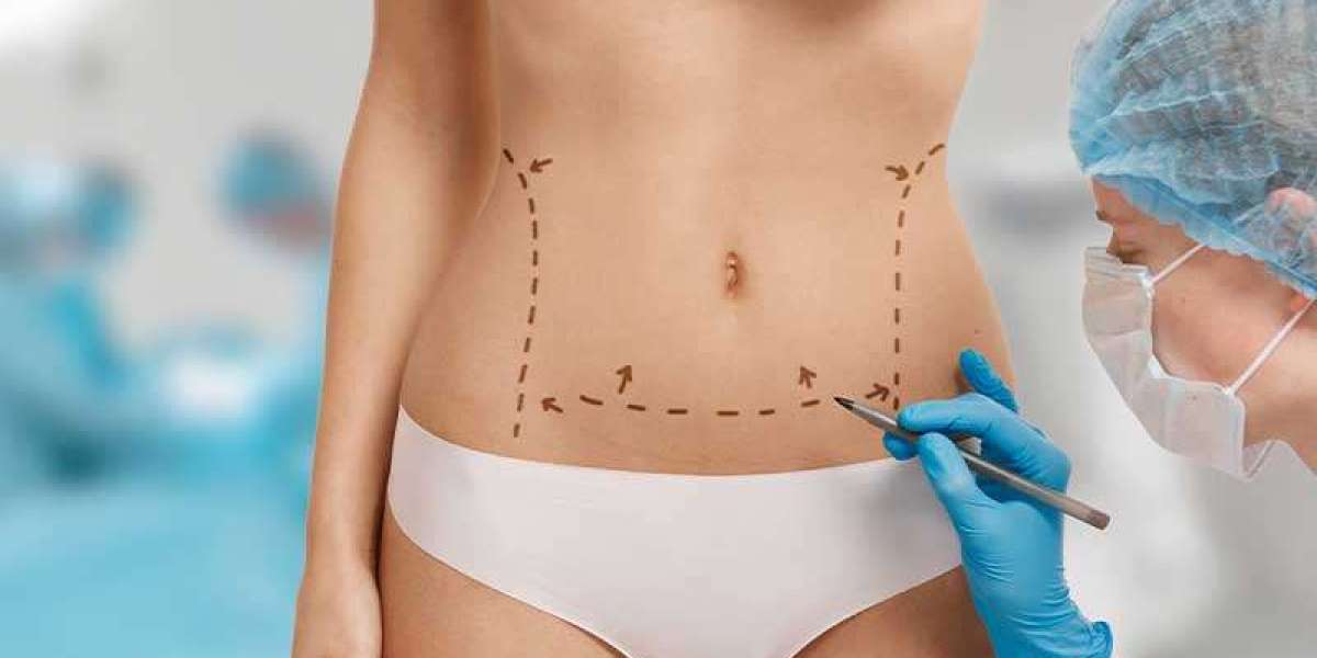 The Evolution of Liposuction: From Traditional to Modern Techniques