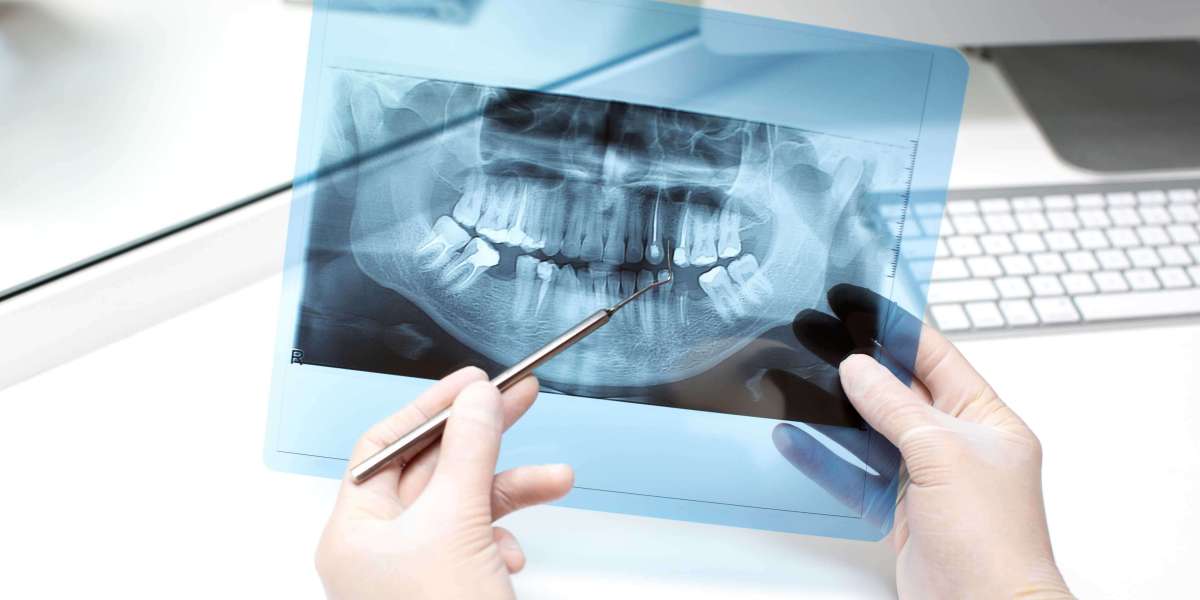Post and Core Solutions for Teeth Affected by Trauma or Fracture