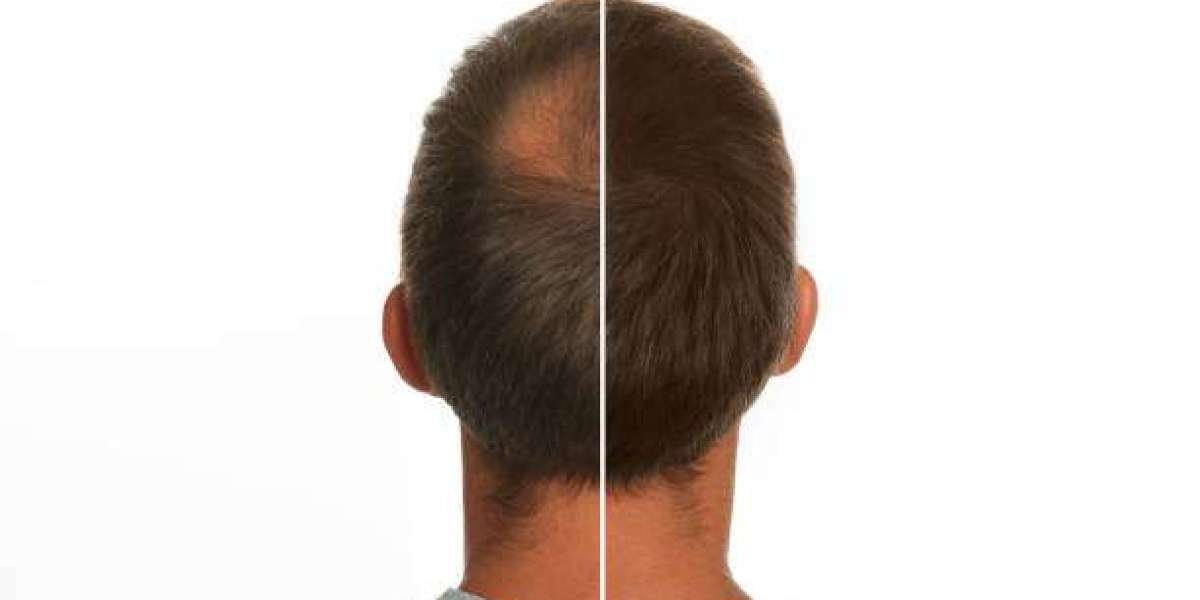 Hair Transplant in Riyadh Step by Step