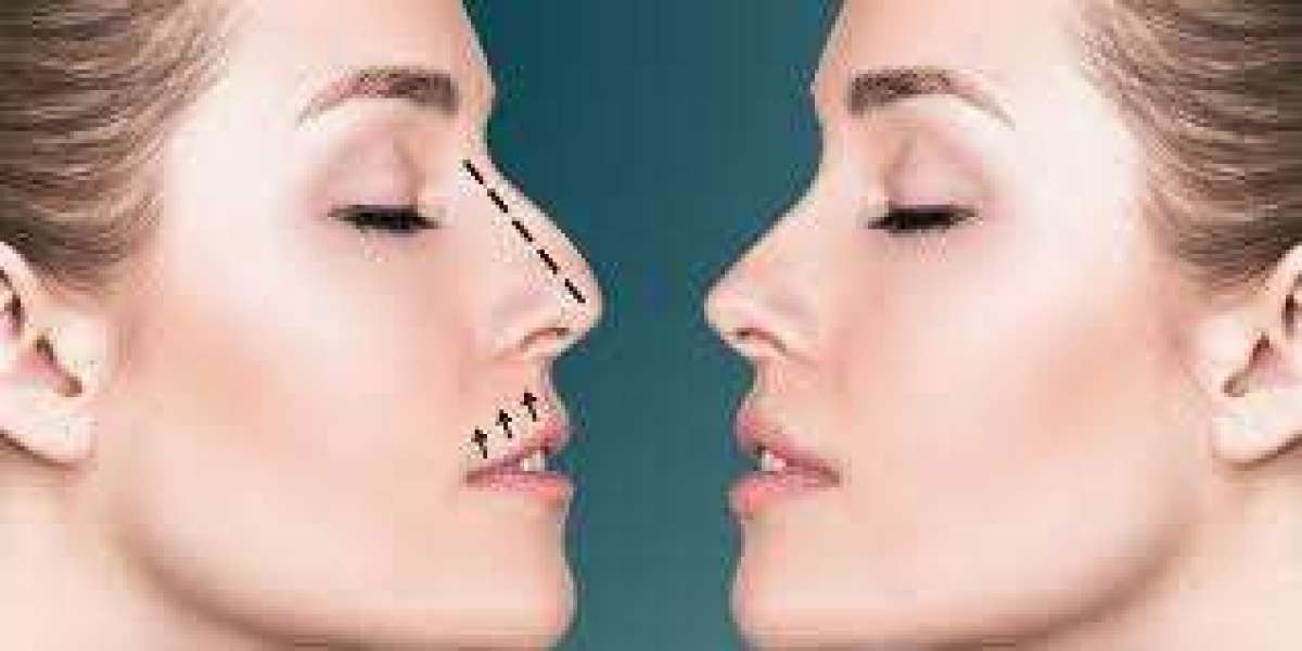 Sleeping Positions Recommended Post-Rhinoplasty in Riyadh
