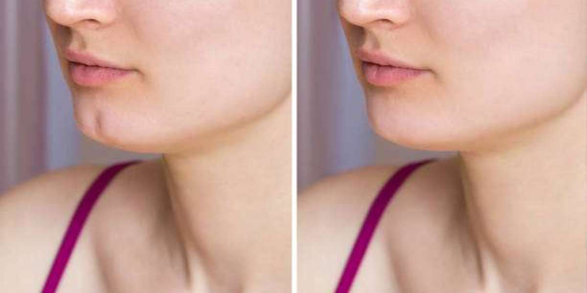 The Psychological Impact of Dimple Creation on Self-Esteem