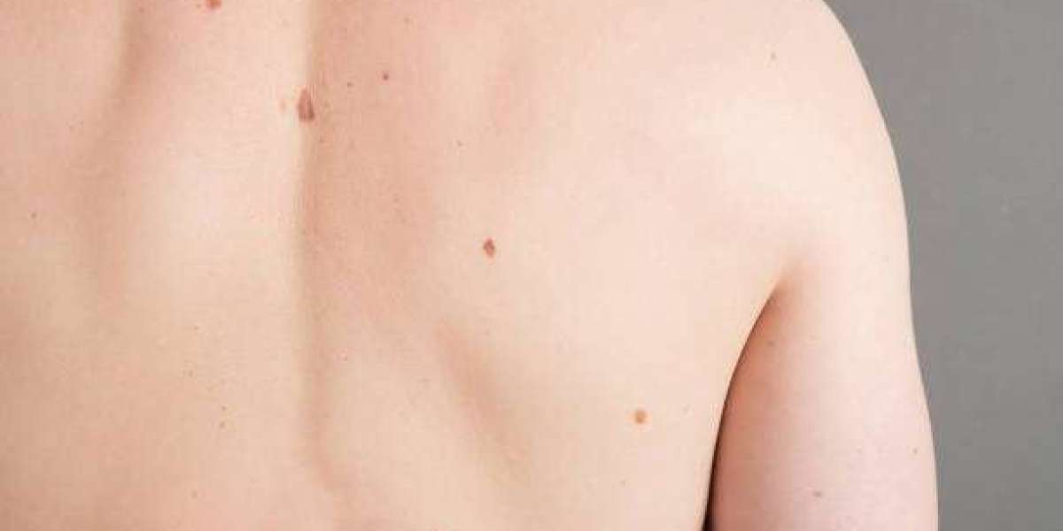 Preparing for Mole Removal: Tips for a Smooth Process