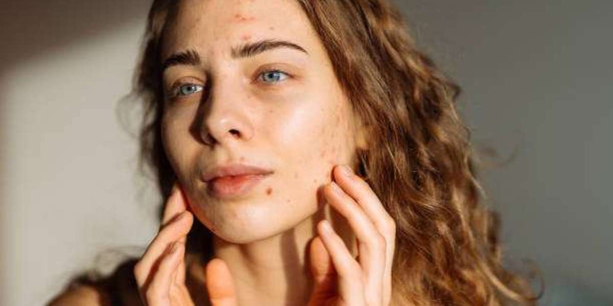 Why Choose Laser Acne Treatment Over Traditional Methods