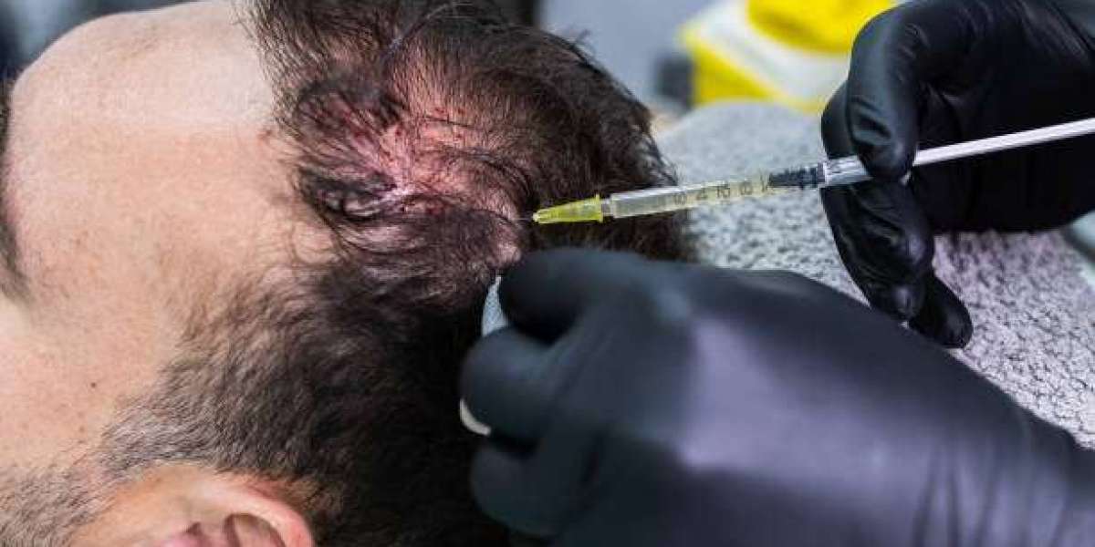 PRP Hair Treatment as a Foundation for Thriving Scalp and Strands