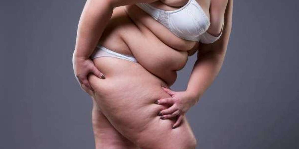 Lipedema Treatment Guide: From Diagnosis to Full Body Wellness