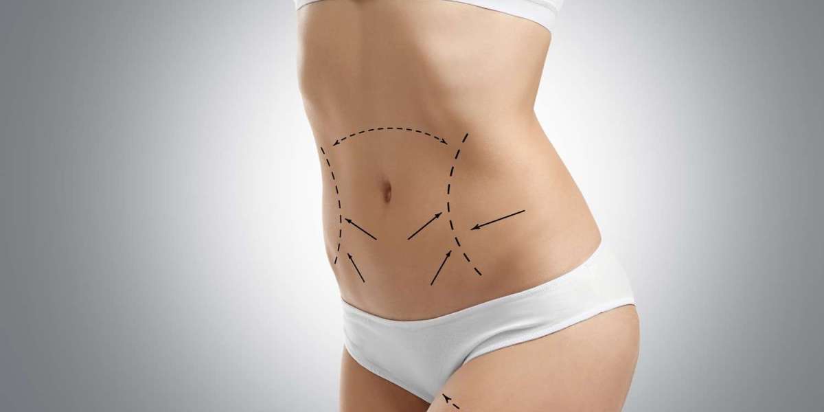 Liposuction Consultation Guide: Questions to Ask Your Surgeon