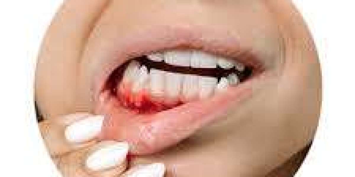 Bleeding from the Mouth in Stratford – Causes, Symptoms & Dental Treatment
